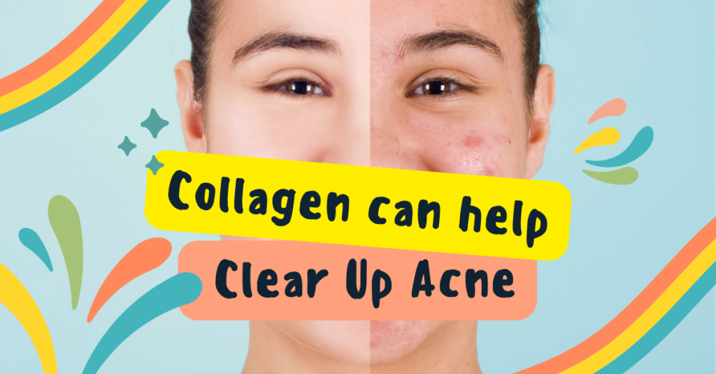 Collagen can help clear up acne