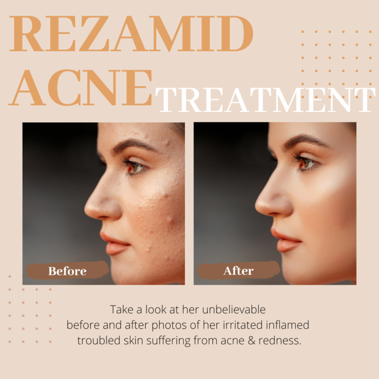 Rezamid Acne Treatment Lotion before and after